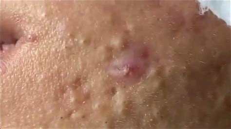 Unbelievable Blackhead Removal 2024: The Ultimate Guide to Poreless Skin - whs62kk