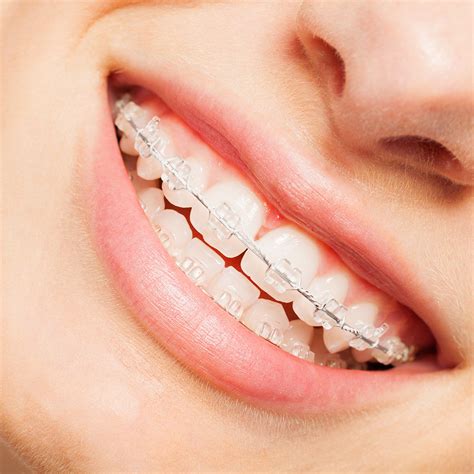 Clear Braces, Braces for Adults | San Antonio TX | Cochran Orthodontics
