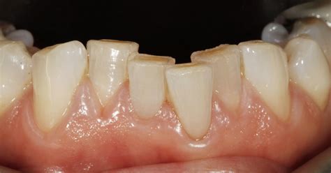 worn teeth teeth erosion treatment fleet dentist