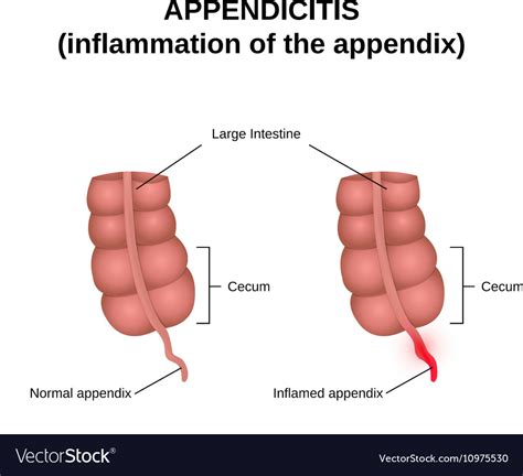 inflammation appendix royalty  vector image