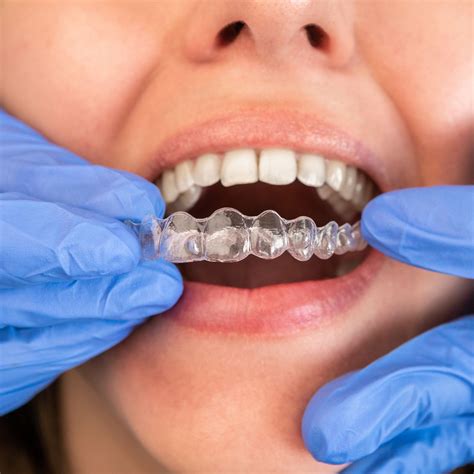 find  good invisalign dentist