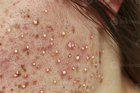 close   human skin  numerous whiteheads  blackheads