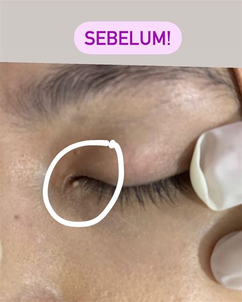 What is milia? A milium cyst is a... - Uniklinikseremban