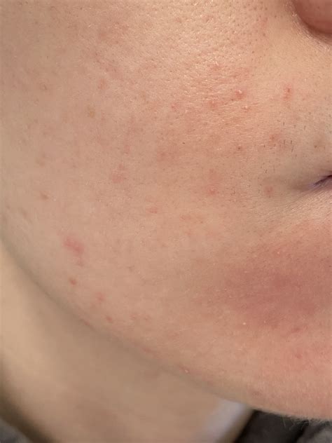 Gram Negative Folliculitis? – Acne – Acne.org Forum