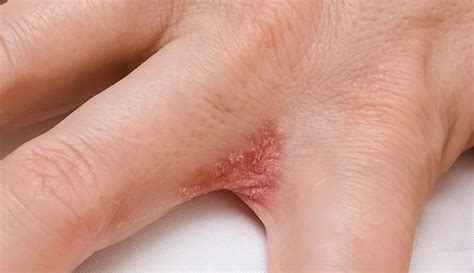 Dyshidrotic Eczema (Dyshidrosis): Symptoms, Causes, Treatments (2023)