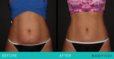 Body Sculpting: Before & After - Southeastern Dermatology