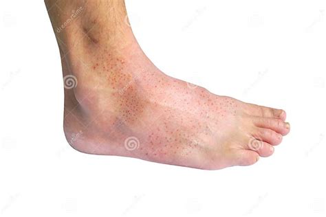 Red rash on foot stock photo. Image of condition, irritants - 163343498