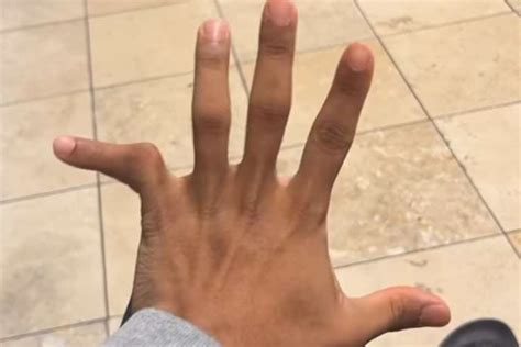 deformed pinky finger  cardinals wr     sanest