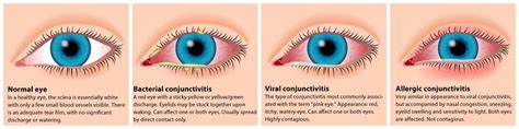 Eye Bacterial Infection