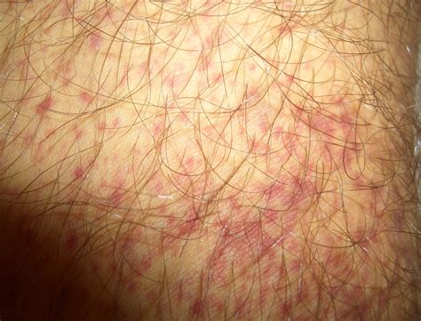 Thrombotic Thrombocytopenic Purpura