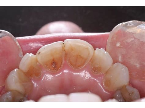 Functional and Esthetic Restoration of the Worn Dentition | PPT