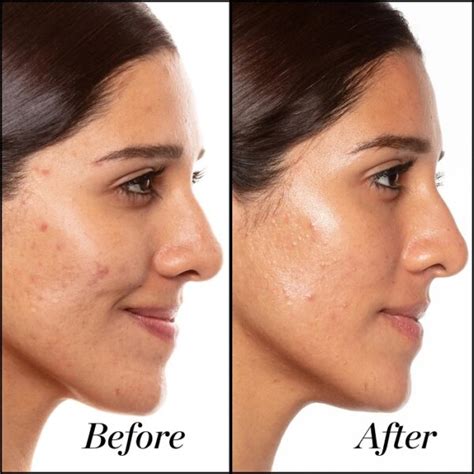 Retinol Before and After: Transform Your Skin with These Results - Must ...