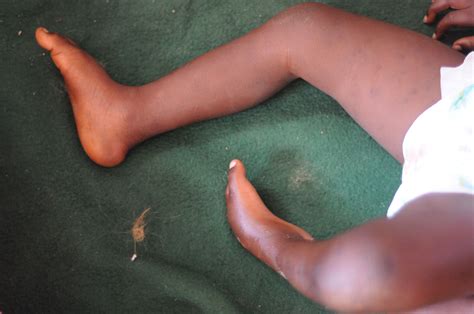 Club Foot - Sante Total