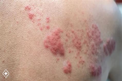 Shingles Rash in Spanish - Symptoms, Treatment, and Care