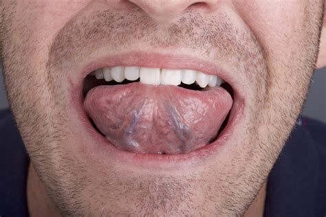 Self Oral Cancer Screening (SOCS) Education Program | School of