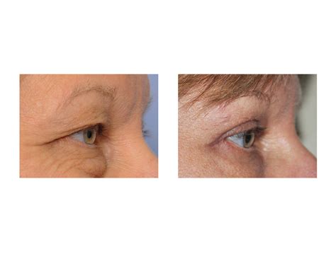 puffy-eye-blepharoplasty-results-side-view-dr-barry-eppley-indianapolis