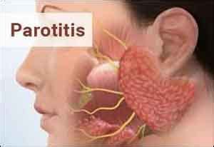 acute parotitis standard treatment guidelines