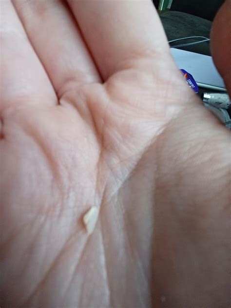 Tooth Filling Fell Out