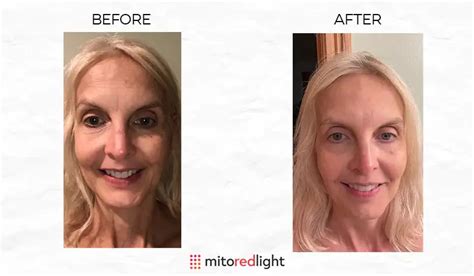 Amazing Red Light Therapy Before and After Photos: Wrinkles, Psoriasis ...