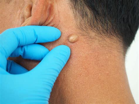 Can Dermatologists Remove Cysts? We Answer Your Questions