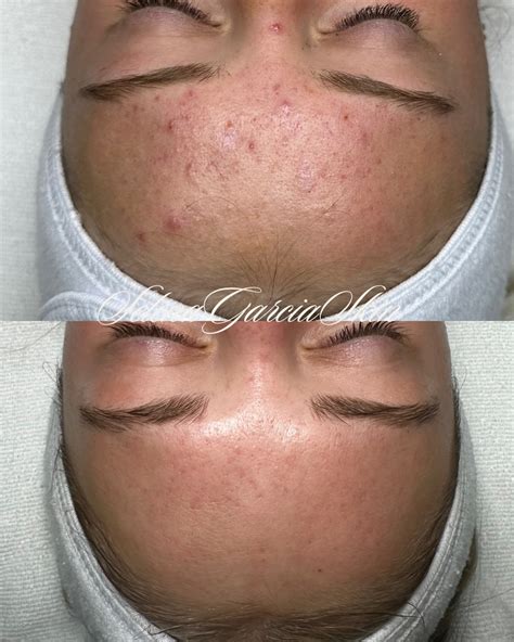 Selena Garcia NWA Aesthetician | A sneak peek of some Acne Bootcamp
