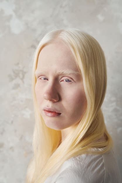 Albino