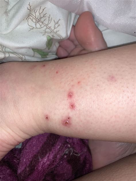 Any ideas for these? I had impetigo a while ago and got these on my