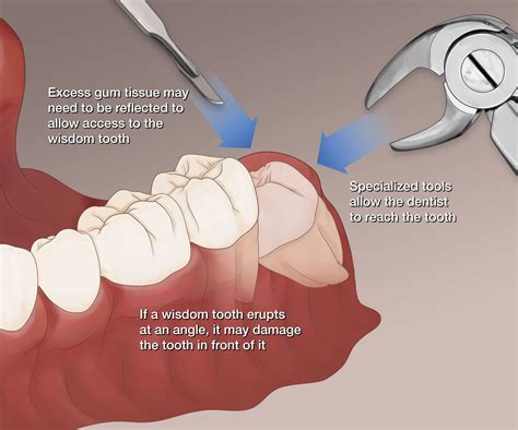 Wisdom Teeth Stitches Fall Out