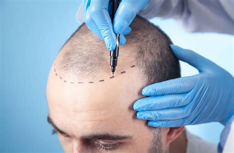 How much does a hair transplant cost? Updated to 2023