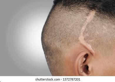head scar   images shutterstock
