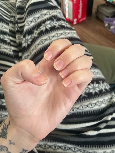 days   biting rnailbiting