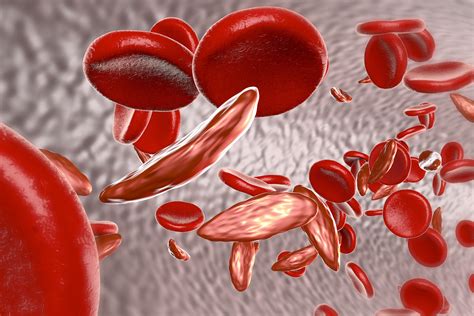 O diagnóstico das formas mais graves das hemoglobinopatias, em ...