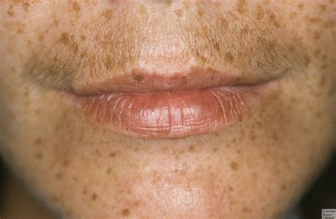 Black People and Freckles - TSMP Medical Blog