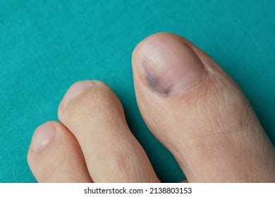 Nail Bruise On Green Background Medicine Stock Photo 2138803153 ...
