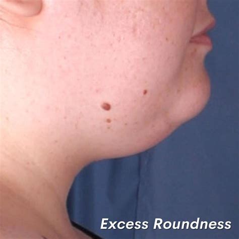 Neck Lift Alternatives: Surgical & Non-surgical Options | Omaha ...