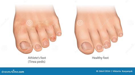 illustration   athletes foot  healthy foot tinea pedis