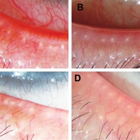 Clinical features of meibomian gland dysfunction. Notes: Eyelid-margin