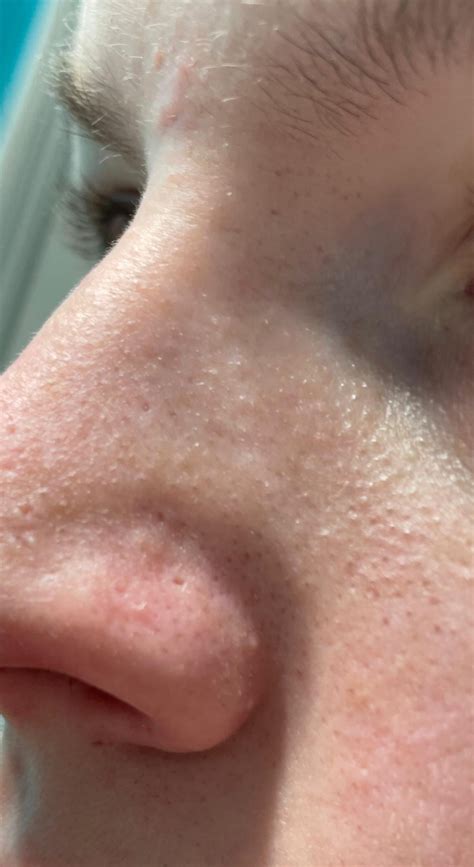 Warning: This Unbelievable Blackhead Removal 2024 Method Is Addictive! Image 10