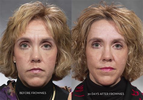do frownies actually work 3