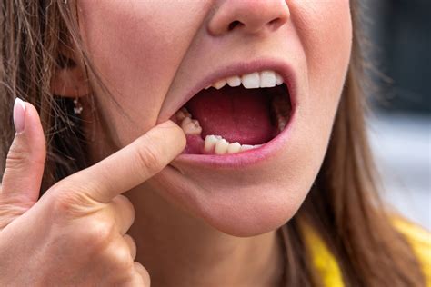 how long do gums take to heal after tooth extraction