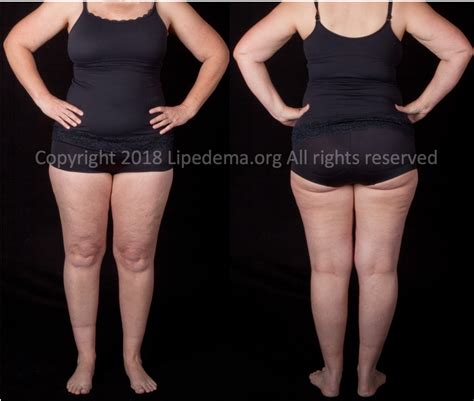 Staging of Lipedema — Lipedema Foundation