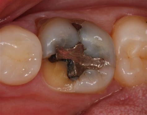 fractured molar dr gurs sehmi