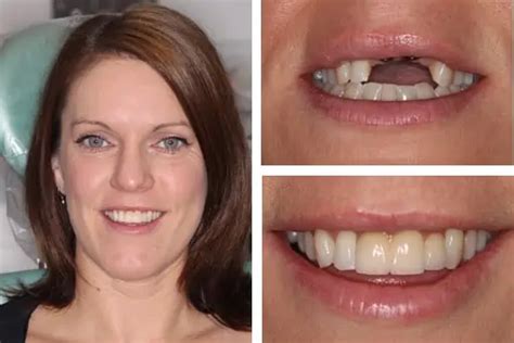 Dental Implants Melbourne - Teeth Implant Procedure Process