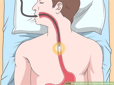 how to know if you have a hiatal hernia