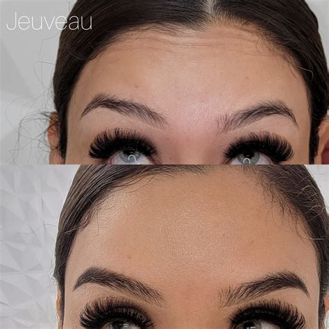 Under Eyes or Hair Restoration with Platelet Rich Plasma (PRP)
