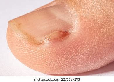 granuloma anular manos