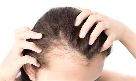 The Bald Truth: 5 Natural Ways To Regrow Your Luscious Locks