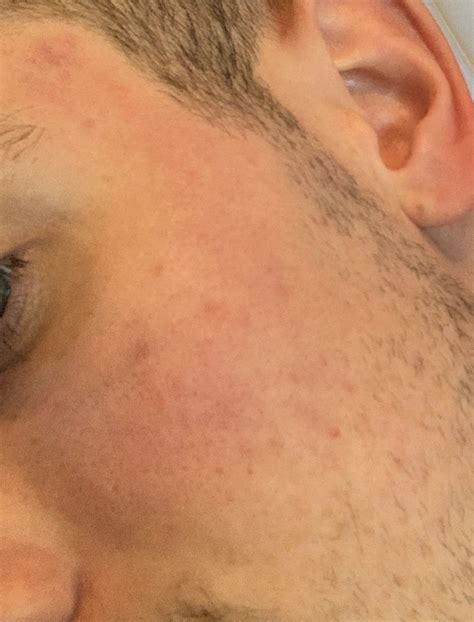 IPL Treatment For Acne Scarring – Hyperpigmentation – red/dark marks