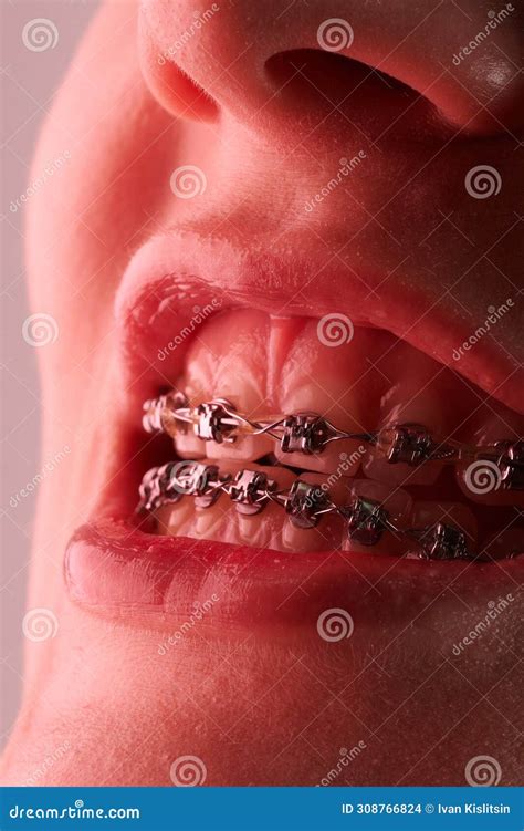 Close-up of a Woman S Mouth with Braces on Teeth Stock Photo - Image of close, professional ...