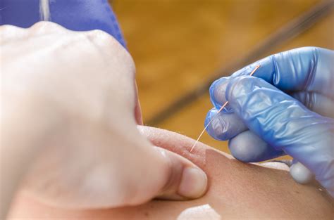 Functional Dry Needling